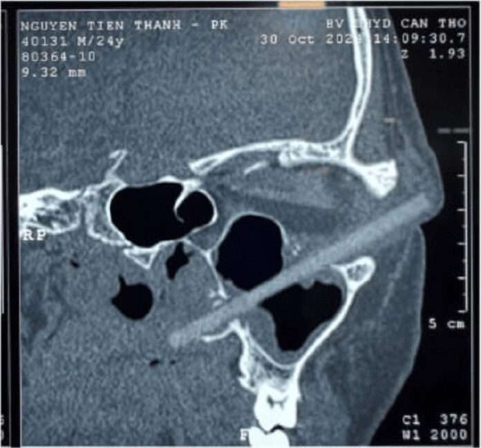 Вьетнамская сюрприз-история: палочка, которая застряла в глазнице – просто экзотика! 🎉 - новости