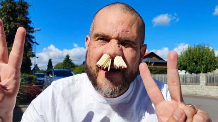 Швед засунул 81 спичку в нос и попал в Книгу рекордов Гиннесса. - новости