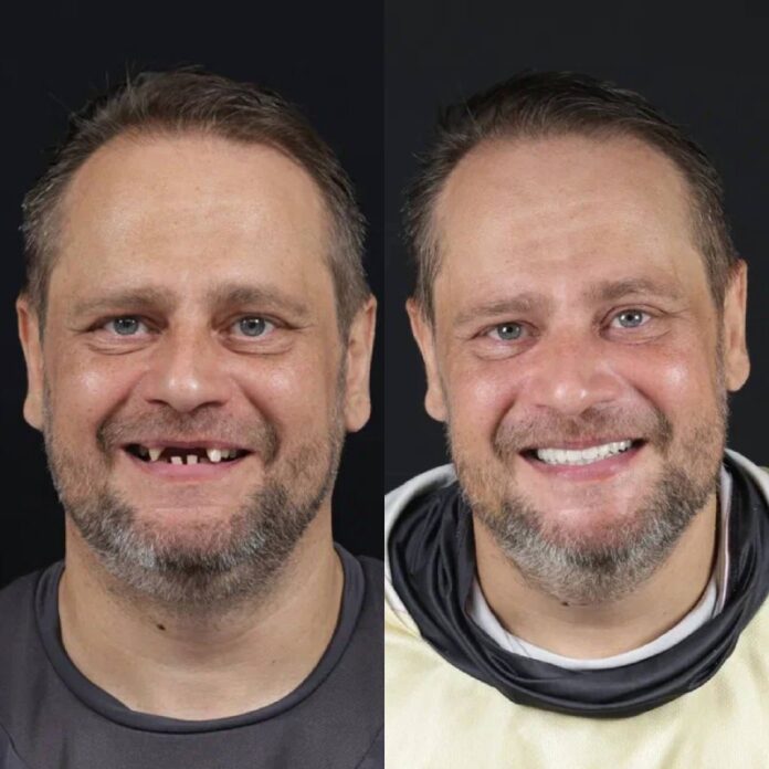 Сравнение до и после установки виниров, демонстрирующее преображение улыбки